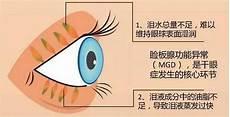 眼睛干涩疼痛吃什么药